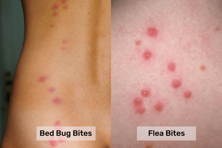 bed bug bites vs flea bites