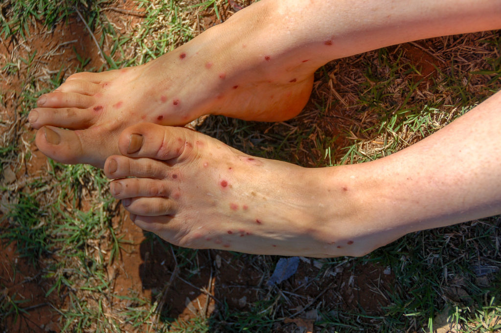 Feet and legs of a woman with midge bites, bitten by hundreds of midges in Western Australia