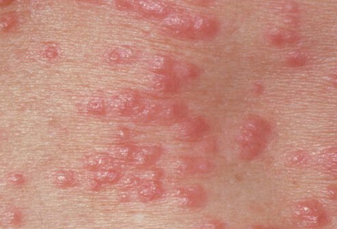 scabies bites