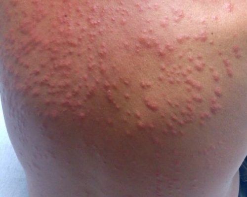 allergic reaction bed bugs
