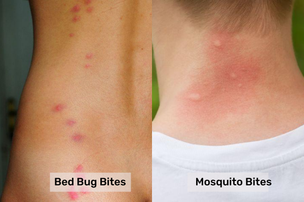 bed bug bites vs mosquito bites